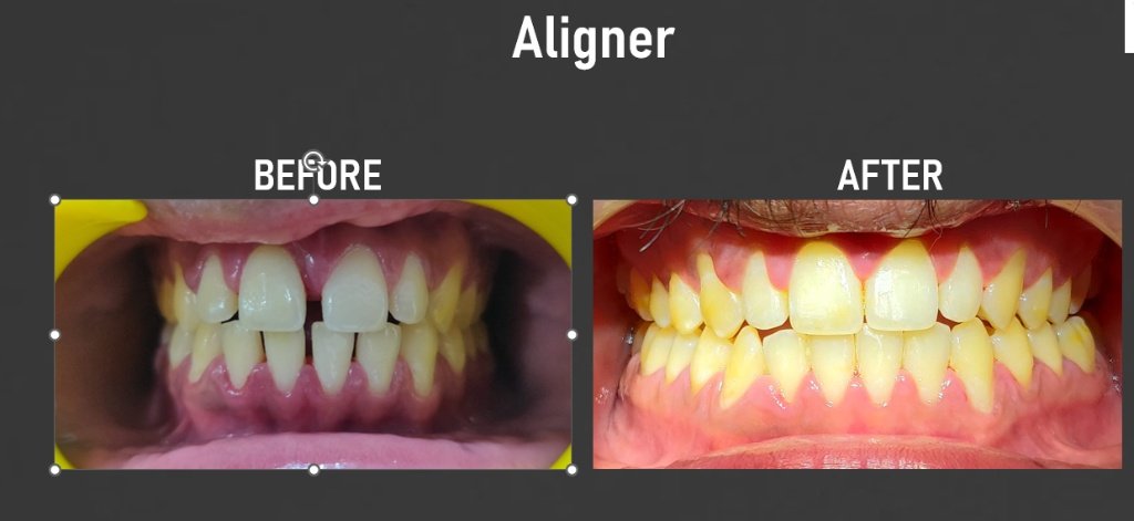 Aligner Treatment Transformation